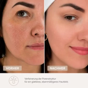 Große Poren Vorher Nachcher