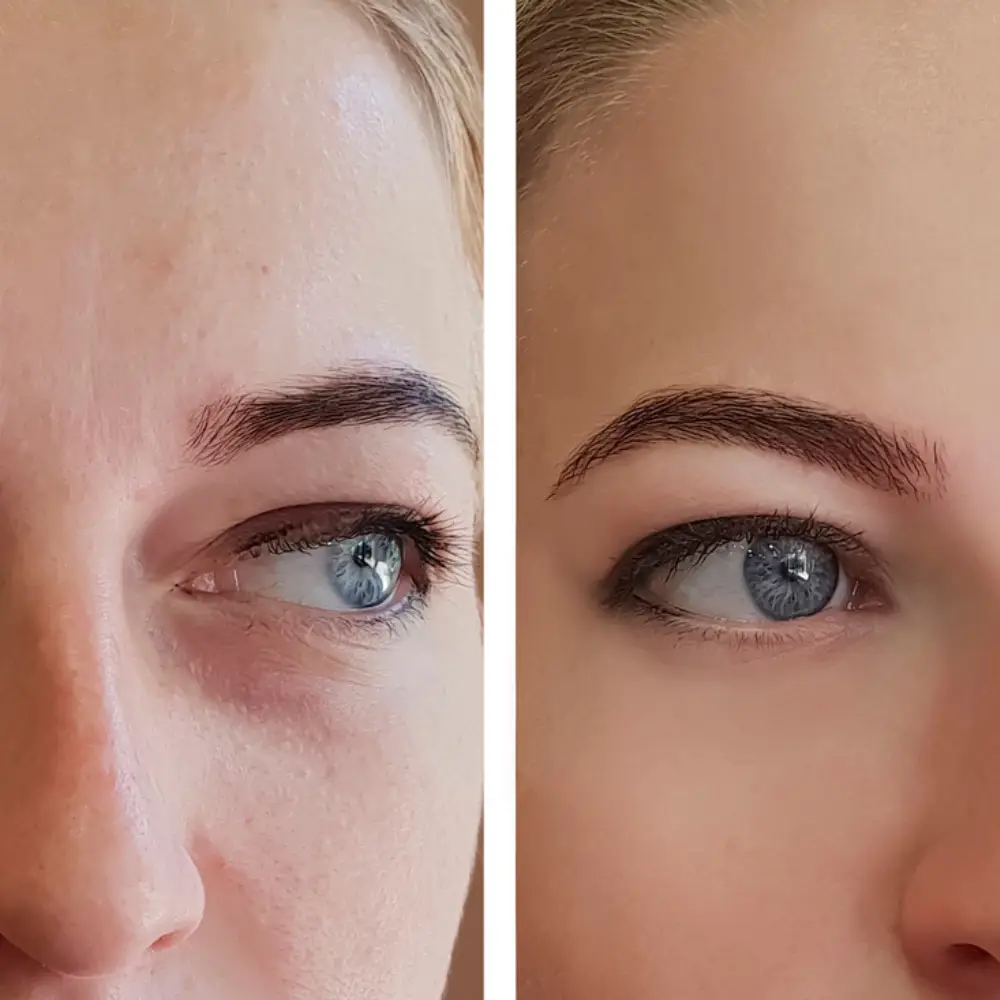Augenringe Vorher NAchher Effekt